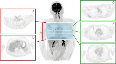 This illustration shows the annotation of PET images for training and testing of the deep-learning algorithm. The researchers assigned the upper (a) and lower (b) lung limits for each subject, with only slices within this lung volume (*) utilized for further analysis. Every image was annotated on a slice-by-slice basis as 0 if no nodule was present (e.g., slices c and e) or 1 if an FDG-avid nodule was present (e.g., slice d). Image courtesy of European Radiology and Schwyzer et al.