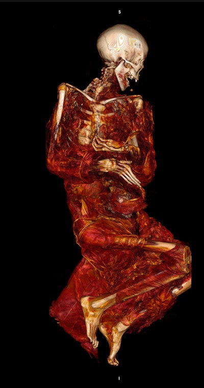 Scout CT scan of a Greenlandic Inuit mummy acquired for diagnostic processing, eventually leading to the detection of vascular calcification. Image courtesy of Dr. Samuel Wann.