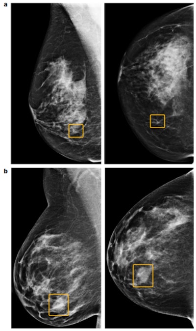 Discrepancies between the AI system and human readers. The top images (a) show a sample cancer case that was missed by all six readers in the U.S. reader study but correctly identified by the AI system. The malignancy, outlined in yellow, is a small, irregular mass with associated microcalcifications in the lower inner right breast. The bottom two images (b) show a sample cancer case that was caught by all six readers in the U.S. reader study but missed by the AI system. The malignancy is a dense mass in the lower inner right breast. Left = mediolateral oblique view; right = craniocaudal view. Images courtesy of Scott Mayer McKinney and colleagues and Nature.