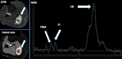65-year-old woman with posterior thigh palpable mass and erythema. An irregular muscular lesion (arrow) was identified with peripheral enhancement. MRS showed high lip peak consistent with necrosis and small trimethylamine (TMA) peak that suggests high membrane turnover. The findings were consistent with soft-tissue sarcoma (biopsy proven).