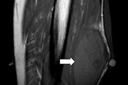 2020 01 06 19 11 0163 Mcl 70 Neurofibromatosis 20200106192555