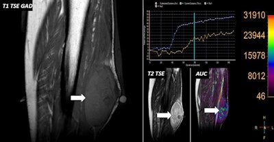 70-year-old woman with neurofibromatosis and palpable lump in her leg. MRI confirmed the presence of a well-defined lesion with scarce enhancement on postgadolinium images (white arrows). DCE-MRI analysis showed fast wash-in (blue curve) within lesion compared with tibial anterior muscle used as internal reference (orange curve) as well as higher relative enhancement values.