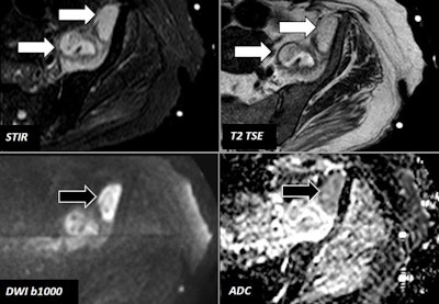 78-year-old woman with fever and left hip pain. MRI identified two loculated lesions at the left psoas muscle (white arrows). Both lesions showed restriction of water diffusion, but the lesion located in the vicinity of the anterior-superior iliac margin (black arrows) demonstrated a higher degree of water diffusion -- data used to select the target lesion for fine-needle aspiration. Soft-tissue abscesses were demonstrated by fine-needle aspiration. All images courtesy of Dr. Teodoro Martín Noguerol.