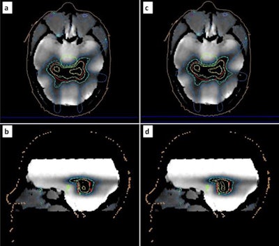 Reconstructed maps from a postirradiation MR scan of the gel-filled phantom. Corresponding relative dose measurements are superimposed (dashed isolines) for comparison with relative dose calculations (solid isolines) related to the adapted (a, b) and original (c, d) treatment plans. Blue, turquoise, green, and yellow isolines correspond to the 40%, 60%, 80%, and 100% isodose, respectively. The PTV, organ at risk, and external surface are depicted by red, green, and brown contours, respectively. Image courtesy of Pappas and colleagues.