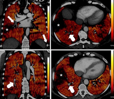 PBV images of a 46-year-old woman with right-sided emboli. Coronal PBV image (top left) shows clot in the anterior lower lobe artery (arrow) with total lumen obstruction and PBV defect (asterisk). Coronal (bottom left) and axial (top and bottom right) PBV images of the same patient show a nonobstructing clot in the posterior lower lobe artery (rounded arrows) without associated PBV defect. Asterisks in the right images indicate PBV defect due to obstructing clot shown in top left image. All images courtesy of Dr. Aleksander Kosmala.