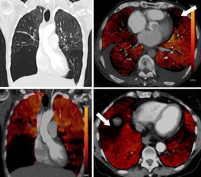 Coronal images (top and bottom left) of a 49-year-old woman with alpha-1 antitrypsin deficiency show advanced lower lobe emphysema with correlating PBV defects. Motion artifacts due to cardiac or respiratory motion typically cause PBV pseudodefects adjacent to the heart or hemidiaphragm. Axial PBV images show PBV pseudodefects due to cardiac motion (top right) and diaphragm motion (bottom right) (arrows).