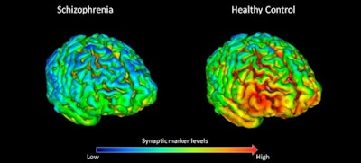 PET scans show that 18 healthy volunteers (right) have, on average, higher levels (shown by yellow-red) of synapse marker protein SV2A than 18 study participants with schizophrenia (left). Images courtesy of Dr. Ellis Onwordi from MRC LMS.