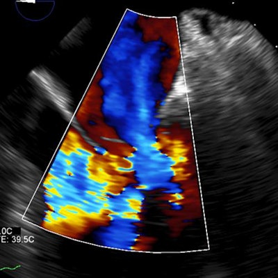 Eccentric regurgitation seen at echocardiography