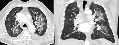 In this case of atypical pulmonary edema, predominant left-sided edema is due to acute mitral valve rupture with eccentric regurgitation seen at echocardiography. Bilateral pleural effusion is also seen. All images courtesy of Dr. Juan Arenas-Jiménez, PhD.
