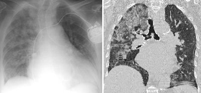 An 89-year-old woman presented with dyspnea and elevated D-dimer. Cardiomegaly and marked elevated proBNP suggested the diagnosis of unilateral pulmonary edema that resolved after diuretic treatment. D-dimer levels are elevated in most patients with acute thrombosis, but the levels also are increased in advanced age, after surgery, during pregnancy and puerperium, with cancer and other chronic inflammatory conditions, and in many other disorders. D-dimer elevation is the cause of request for many CT angiograms that finally reveal an alternative diagnosis causing dyspnea.