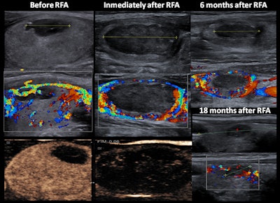 A 27-year-old woman with a solid-cystic nodule had peripheral vascularity and homogeneous enhancement. During follow-up, enlargement of the peripheral residual portion was observed (at six months). At 18 months after RF ablation (RFA), reduction of size and vascularity were observed. All images courtesy of Dr. José Miguel Escudero-Fernández and colleagues.