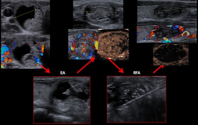 A 38-year-old woman with a solid-cystic nodule was treated with ethanol ablation (EA) before the RF ablation.