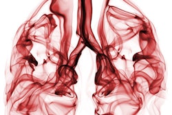 2018 05 01 17 36 7840 Lungs Smoke 400