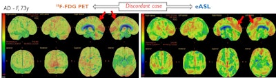 2020 02 05 17 11 6452 Fdg Pet Asl Mr Alzheimers
