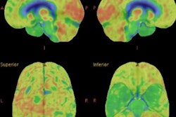 2020 02 05 17 44 6057 Fdg Pet Asl Mr Alzheimers 400