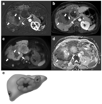 A 49-year-old woman with a gallbladder neuroendocrine tumor. A and B: On subtraction imaging of arterial phase and delayed phase of axial contrast-enhanced MRI, a 14.7-cm mass replacing the gallbladder and invading the liver is demonstrated. The mass shows thick rim enhancement with a thick peripheral enhancement and washout (arrows). Note the delayed central enhancement (arrowhead). On diffusion-weighted imaging (C) and apparent diffusion coefficient mapping (D), this mass also depicts a thick rim diffusion restriction (arrows). The diagnosis of neuroendocrine tumor was made via percutaneous biopsy. E: Thick rim appearance. All images courtesy of Drs. Jae Seok Bae, Se Hyung Kim, and colleagues and European Radiology.