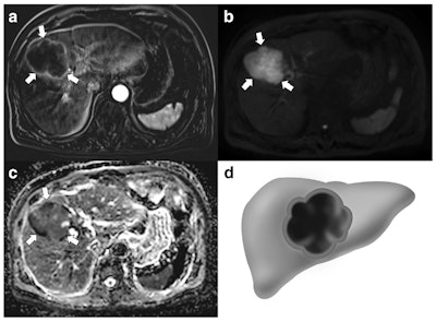A 76-year-old man with gallbladder adenocarcinoma. A: Subtraction images taken during the arterial phase of an axial contrast-enhanced MRI show a 7.5-cm mass replacing the gallbladder with thin peripheral rim enhancement (arrows). On diffusion-weighted imaging (B) and apparent diffusion coefficient mapping (C), this mass demonstrates a nonthick rim appearance (arrows). Extended right lobectomy was performed, and a poorly differentiated adenocarcinoma was histopathologically confirmed. D: Nonthick rim appearance.