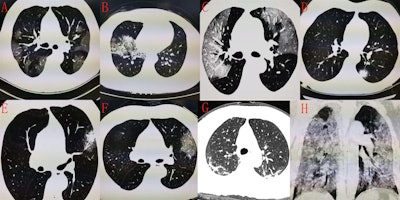 CT scans of a patient with the novel coronavirus showing ground-glass opacities (A-C), pulmonary consolidation and nodules (D), local consolidation with peripheral ground-glass opacity (E), ground-glass opacities resembling 'melted sugar' (F), inflammation absorbed by the lungs (G), and pneumonia in the white-lung stage (H). Figure courtesy of European Radiology.