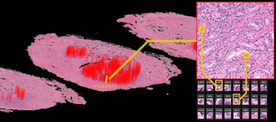 The deep-learning algorithm automatically annotates a 3D whole-mount pathology image and presents the discovered features in an understandable way. The patches with high probability of cancer recurrence are shown by color and height. Image courtesy of Riken.