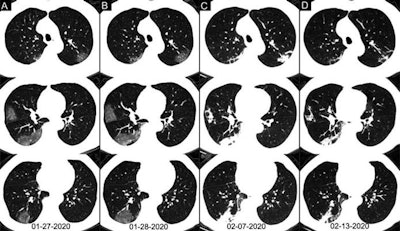Axial chest CT images of a 62-year-old man with COVID-19 showing disease progression over time, from bilateral ground-glass opacities on 27 January (A) to multifocal organizing consolidation on 13 February (D). He had multiple negative results from RT-PCR tests, including those obtained on 3 and 11 February. Image courtesy of the RSNA.