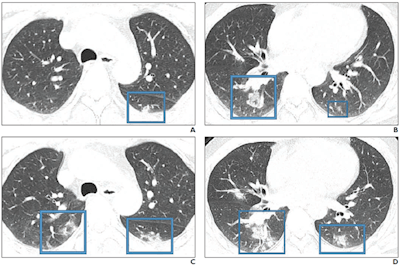 47-year-old Chinese man with two-day history of fever, chills, productive cough, sneezing, and fatigue who presented to the emergency department. A and B: Initial CT images obtained show small round areas of mixed ground-glass opacity and consolidation (rectangles) at level of aortic arch (A) and ventricles (B) in right and left lower lobe posterior zones. C and D: Follow-up CT images obtained two days later show progression of abnormalities (rectangles) at the level of aortic arch (C) and ventricles (D), which now involve right upper and right and left lower lobe posterior zones. Images courtesy of the American Journal of Roentgenology.