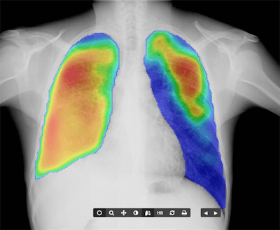 Delft's CAD4TB algorithm is trained to detect tuberculosis on radiography exams. Image courtesy of Delft/Canon.