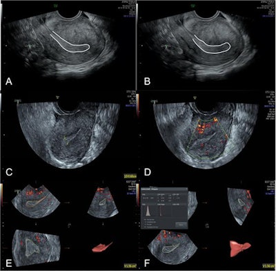 Ultrasound images of a subject in the AA group. (A, B) 2D grayscale mode; two images during observation. White curve, outline of endometrium. No endometrium peristalsis wave within 3 minutes; score, 1; (C) 2D grayscale mode; endometrial thickness, 6.0 mm; score, 1; endometrial type, type C; score, 1; (D) 2D color Doppler mode; a little blood flow in the subendometrium; score, 2; (E) 3D mode; EV, 1.56 cm3; score, 1; (F) 3D mode; VFI, 0.027; score, 2. Image courtesy of Insights into Imaging.