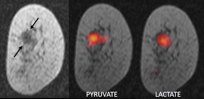 MR imaging of a breast tumor. Left panel: anatomic image of a breast cancer (arrows); middle panel: pyruvate in the tumor; right panel: lactate in the tumor. All images courtesy of Dr. Ramona Woitek, PhD.