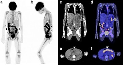 FDG-PET/CT helped to establish a final diagnosis in a 9-year-old boy with fever of unknown origin. a, b: FDG-PET scans; c, e: low-dose CT; d, f: fused FDG-PET/CT. Image courtesy of Eur J Nucl Med Mol Imaging, Pijl et al, 7 February 2020.