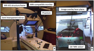 An augmented reality technique for MRI-guided musculoskeletal interventions. The Magnetic Resonance Image Overlay System (MR-IOS) allows users wearing an augmented reality headset to view a projection of MR images overlaid onto a patient lying on an MRI scanner bed. Image licensed under CC BY-NC 4.0.