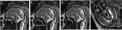 MR images shows fetal measurements for maximal nasal length between the nasal tip and the posterior wall of the nasopharynx (E, white arrow), mandibular vertebral length (F, white arrow), septal height (G, white arrow), and septal length (H, white arrow). Images courtesy of EJR.