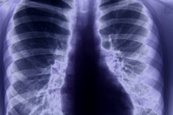 2020 03 20 17 36 4240 X Ray Chest Lungs2 400