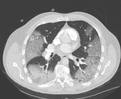 CT scan of a COVID-19 patient who was originally referred for CT angiography of the chest to exclude pulmonary embolism. The ground-glass opacifications are clearly depicted, with a consolidation in the right lower lobe.
