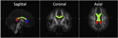 DTI-MR images are examples of the corpus callosum and its substructures -- genu (blue), body (green), and splenium (red) -- used in this study, as defined by software from Johns Hopkins University. Image courtesy of the European Journal of Radiology.