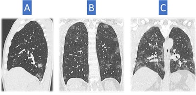 CT scans of three different patients depict typical findings for COVID-19 pneumonia. These look different in severity. Image A shows patchy rounded ground-glass opacities, essentially distributed in the right lower lobe. This is not an unusual feature of infection; therefore, it is difficult to make a differential diagnosis with x-ray. Image B shows several ground-glass opacities, rounded in shape and distributed mainly in the superior regions of the lung, a classic distribution of COVID-19 pneumonia-related abnormalities. Image C depicts ground-glass opacities that are more severe in extent with patchy distribution, occupying a greater volume of the lung. All findings are typical of COVID-19 pneumonia but are not very specific. All images courtesy of Dr. Nicola Sverzellati.