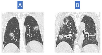 Image A shows larger opacities rounded in shape and some consolidation with a halo of ground glass. This sign has been described in COVID-19 cases. Consolidation is also present in image B, but the consolidation looks a bit different with architectural distortion, consistent with an organizing phase of COVID-19 pneumonia. These show a later stage of pneumonia than in the first three examples.