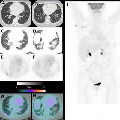 Images include high-resolution thoracic CT with no sign of pneumonia (A, B). PET/CT performed one week later, showing bilateral pneumonia with ground-glass opacities at CT (C, D), PET (E, F), and PET/CT fused images (G, H) with SUVmax of five. Maximum intensity projection (I) shows axillary nodal lesion as FDG positive. Images courtesy of Journal of Nuclear Medicine.