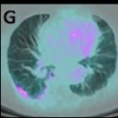 2020 04 02 22 53 2693 2020 04 02)covid 19 Fdg Pet Ct Jnm Albano Image G 400