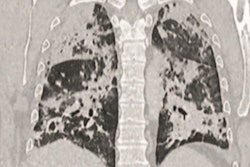 2020 04 09 22 04 9662 Covid Fdg Pet Ct Images Leutje 400