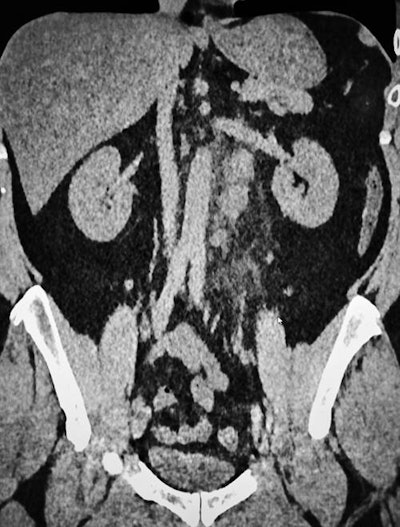 A 53-year-old man referred for suspected COVID-19, with cough, moderate fever, and vague and diffuse abdominal pain. CT shows mild ground-glass lesions and retroperitoneal lymph nodes with inflammatory fat reaction. All images courtesy of Dr. Robert Lavayssière.