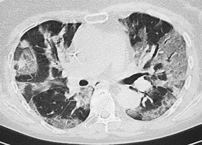 A 63-year-old woman who previously had breast cancer. She presented with severe dyspnea and a fever of 39.5° C, plus oxygen desaturation. CT scan confirms severe disease greater than 70%, mixed type.