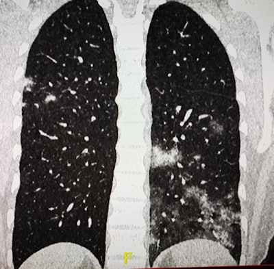 A 39-year-old woman with light cough but no fever. CT reveals patchy ground-glass lesions, left lower lobe predominant.