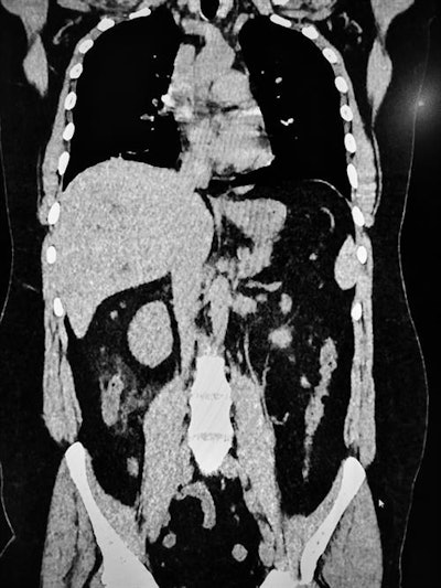 A 43-year-old woman referred for questionable appendicitis with a fever of 38.5° C and mild right iliac fossa pain with moderate blood count disturbance. Lower chest CT slices show some ground-glass lesions, and a chest CT confirms COVID-19 suspicion.