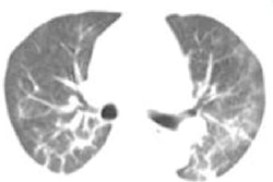 2020 04 15 16 10 1152 2020 04 15 Ct Features Covid China 400