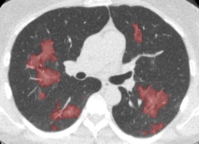 Thirona's CAD4COVID-CT software for triage of COVID-19 on CT images. All images courtesy of Thirona.
