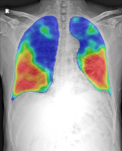 Thirona's CAD4COVID software for triage of COVID‑19.