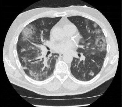 Low-dose CT shows a patient with a score of CO-RADS 5. Image courtesy of Dr. Mathias Prokop, PhD.