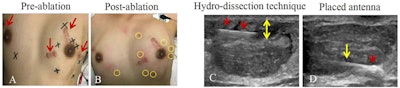 Technical success of microwave ablation (MWA) in a 20-year-old woman with eight fibroadenoma in bilateral breast. Pictured above: A: Appearance of the skin before MWA. Red arrow points to scar from surgery for fibroadenoma before nine months. Black marker indicates location of breast lesions. B: Yellow ring indicates needle site after MWA. C: Needle (red arrows) was inserted into space between lesion margin and skin to infusion of saline, which increased distance (yellow arrow) between lesion and skin. D: Ultrasound shows antenna tip was placed in deepest site of lesion increased echogenicity (red arrow) near irradiating segment of antenna (yellow arrow) at beginning of MWA session. Images courtesy of European Radiology.