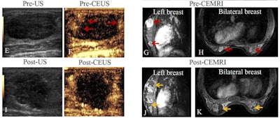 Above (same patient): E: Ultrasound shows hypoechoic lesion before MWA. F: Contrast-enhanced ultrasound shows lesion is hyper-enhancement (red arrow) at margin of lesion in arterial phase. G, H: Transverse contrast-enhanced MRI shows hyperintensity lesion in bilateral breast (arrow) before MWA in arterial phase. Lesion is adjacent to skin and size is 3.9 cm × 2.6 cm × 2.5 cm. I: Contrast-enhanced ultrasound after MWA shows lesion is non-enhancement in arterial phase. J, K: Contrast-enhanced MRI imaging shows hypointensity treatment zone and peripheral nodular enhancement in arterial phase. Volume of lesion decreased at third day after MWA and the size is 3.3 cm × 2.7 cm × 2.5 cm.