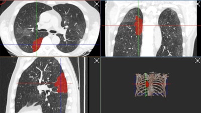 The best AI platforms have a wide range of labeling and segmentation options so that images can be presented correctly. With the RVAI platform from Robovision, the margins of the opacities in the lung are automatically identified by the 'adaptive' brush tool. The lesions or abnormalities are simultaneously segmented in three different planes. In this figure, not all visible opacities have been segmented yet. Images courtesy of Dr. Erik Ranschaert, PhD.